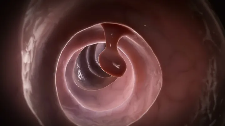 Thumbnail for video about what are colon polyps?