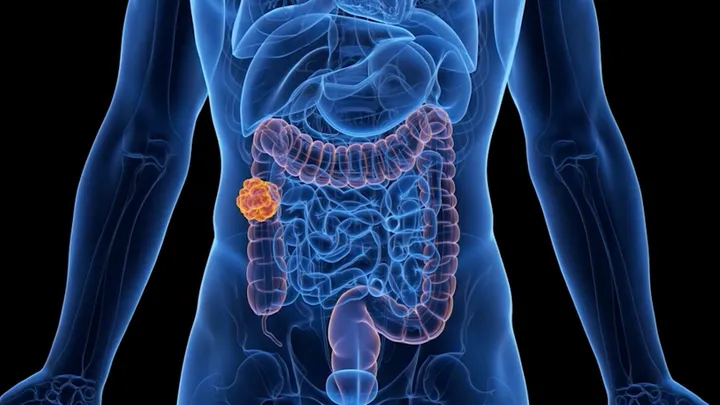 Thumbnail for video about what is colon and rectal cancer?